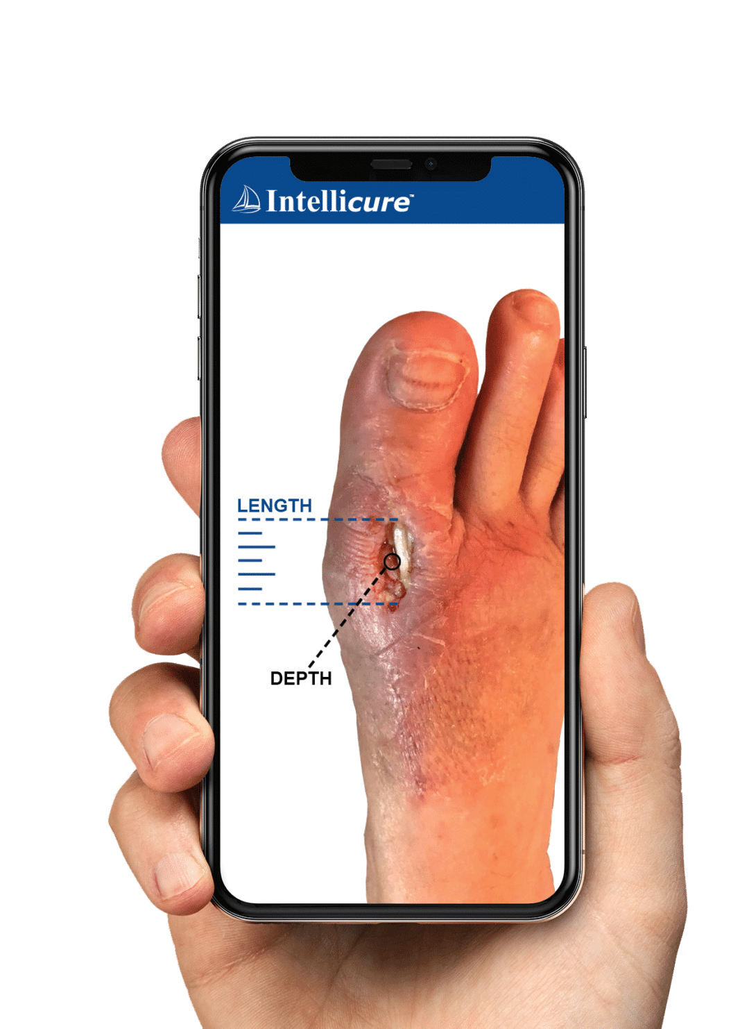 Wound Photo App Wound Photos Instantly Uploaded to Chart Intellicure