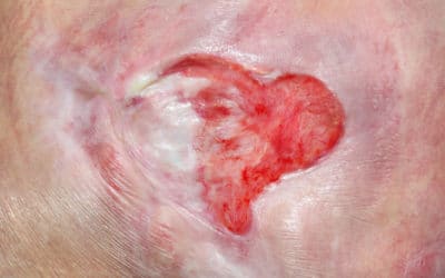 Pressure Ulcer Versus Pressure Injury ICD-10-CM Coding
