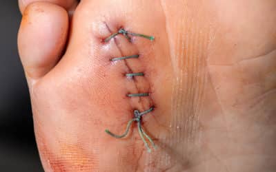 New Suture / Staple Removal CPT® Codes