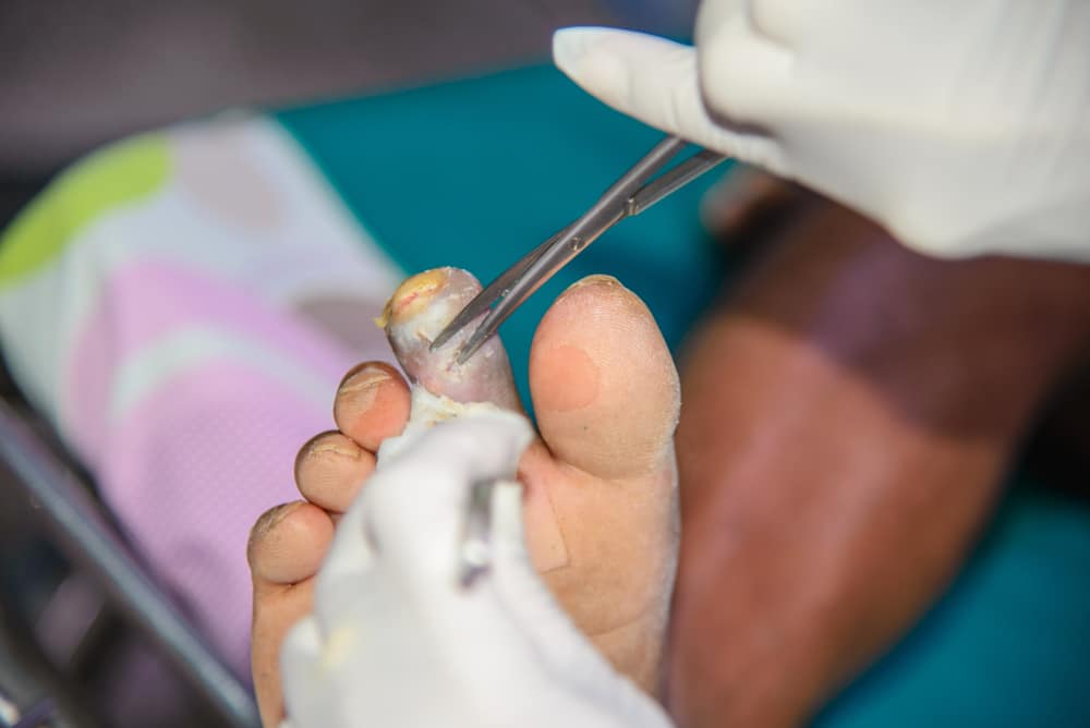 Chiropractors Diabetic Foot Ulcers (DFU)