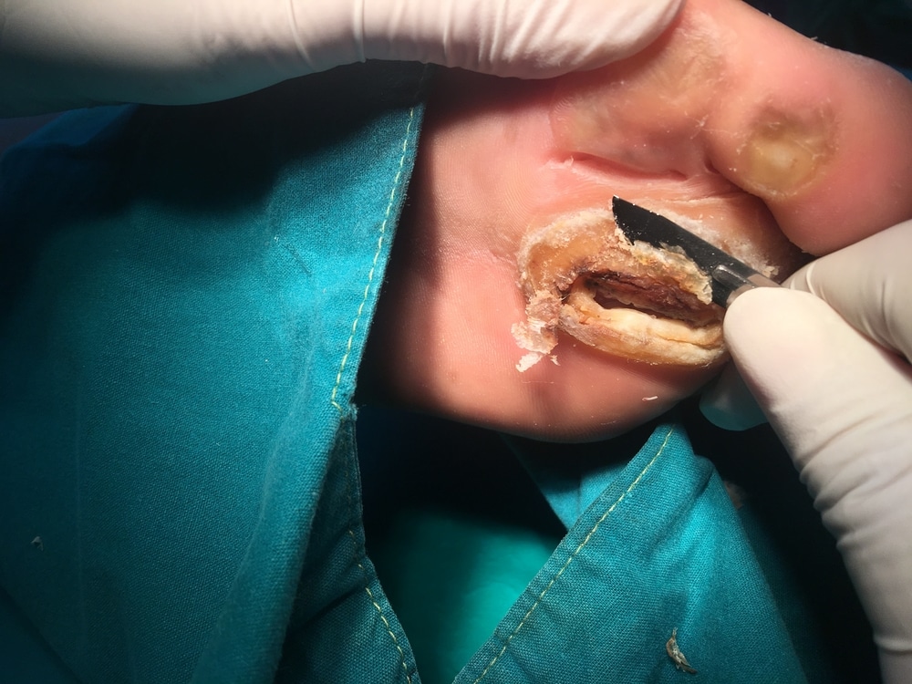 Ulcer Debridement + Total Contact Cast Application