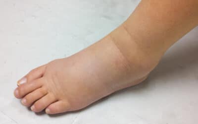Expansion of Lymphedema Treatment