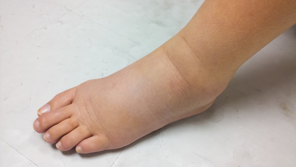 Expansion of Lymphedema Treatment